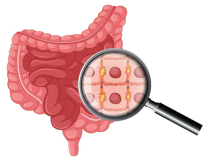 sintomas-obstruccion-intestinal-heelprobiotics-heelespana